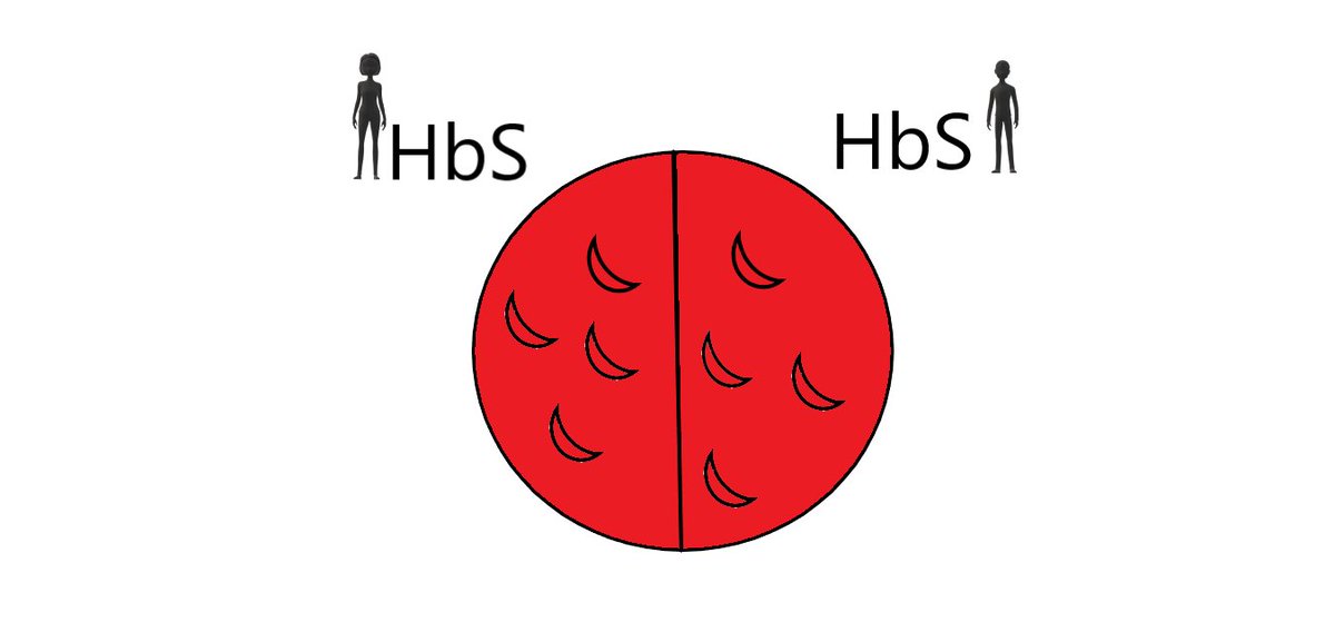 If a person has two genes for HbS, they are HbSS, and 100% of their hemoglobin can sickle. This is the most common type of sickle cell disease. We also call this sickle cell anemia.