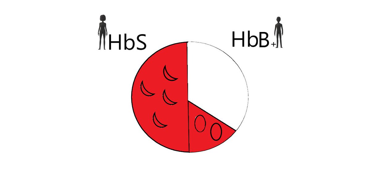 There is a disease called thalassemia where people make normal HbA, but less of it, we will call this HbB+. If someone has one gene for HbS and one for HbB+, they make 50% HbS, and very little HbA due to HbB+, so most of their blood is HbS and they have sickle cell disease.
