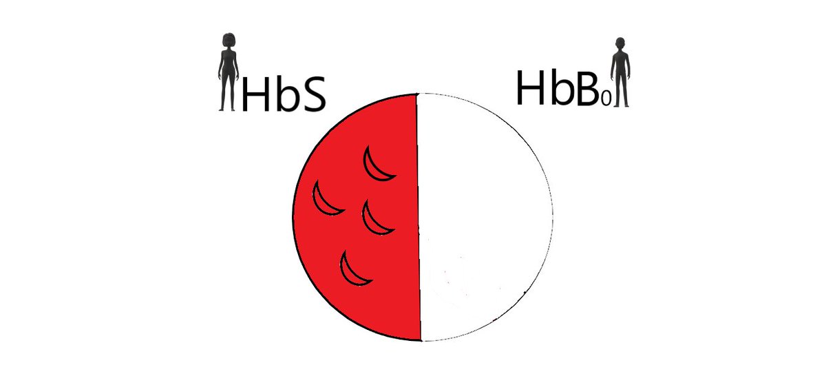 There is a severe type of thalassemia where people make no HbA at all, we call this HbB0. If someone has one gene for HbS and one for Hb0, they are HbSB0. They make 50% HbS and no HbA, so all of their blood is HbS and they have sickle cell disease.