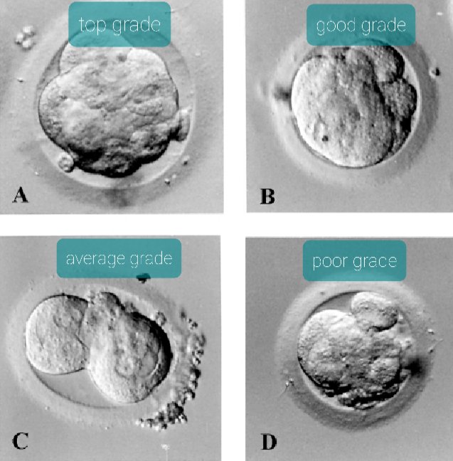 InsideIvf's tweet photo. The morula is a key stage of embryo development often overshadowed by the blastocyst. 

Morulas form around 4 days after fertilisation when cells compact together like a bunch of grapes 🍇 the more cells included in the bunch, the higher the grade and better chance of success💫 https://t.co/hIMhBQe9RY