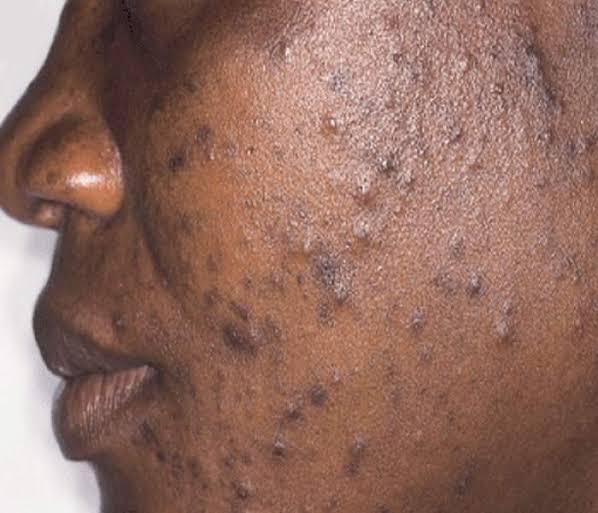 Please listen carefully, I mean pay close attention if you have acne/pimples.First, there are two groups of acne. • non-inflammatory.• inflammatory.Identifying where your acnes belong is a key step to treating it.Re-tweet: thread