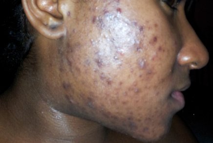 Please listen carefully, I mean pay close attention if you have acne/pimples.First, there are two groups of acne. • non-inflammatory.• inflammatory.Identifying where your acnes belong is a key step to treating it.Re-tweet: thread