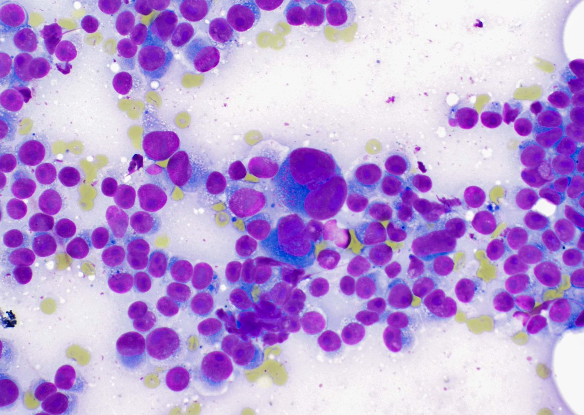 cjvand's tweet photo. Dispersed melanoma cells in an FNA specimen. Eccentrically placed nuclei with very, very large nucleoli. Some with abundant granular and vacuolated cytoplasm. Occasional binucleate forms. Significant nuclear size variation. #cytology #cytopath https://t.co/oh2OWCRHyL