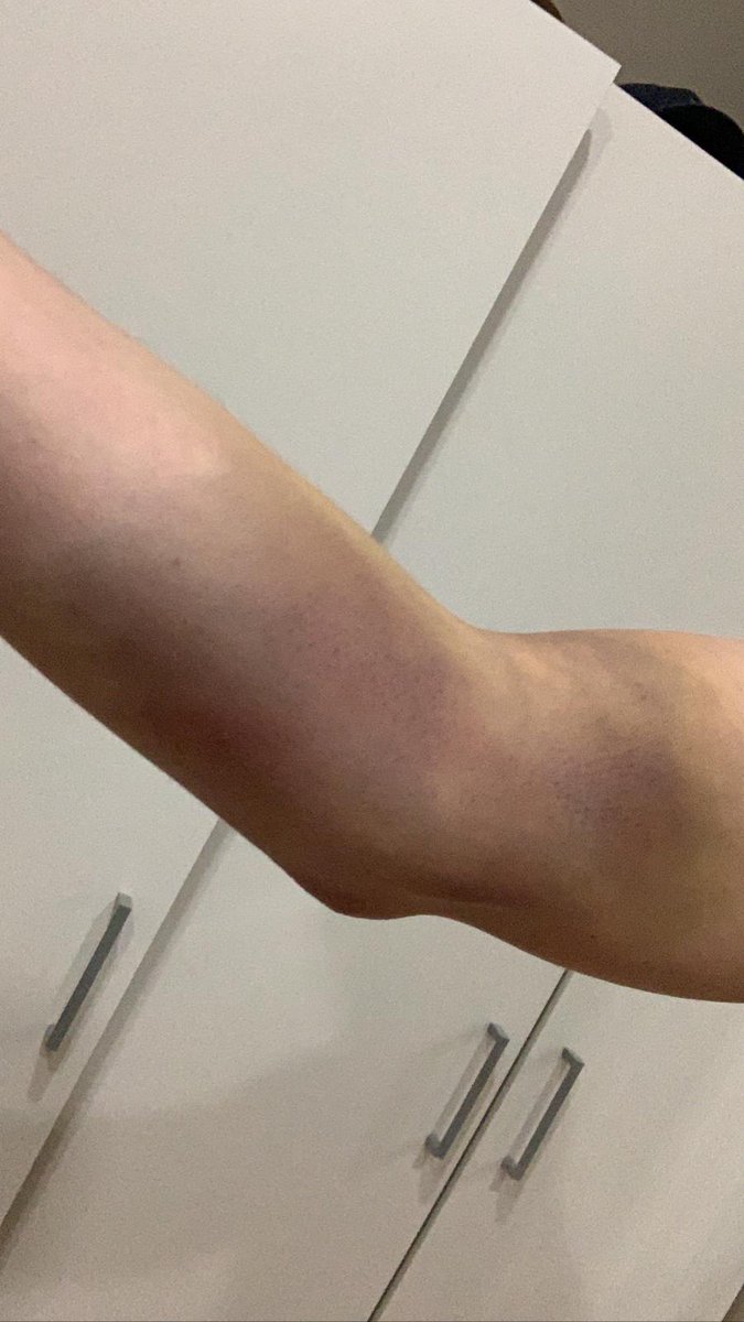 StephLMartin's tweet photo. @NGHnhstrust not a complaint by any means, please PM me for details. Just feel a nurse could benefit from from canular training https://t.co/wtfcIICpv4