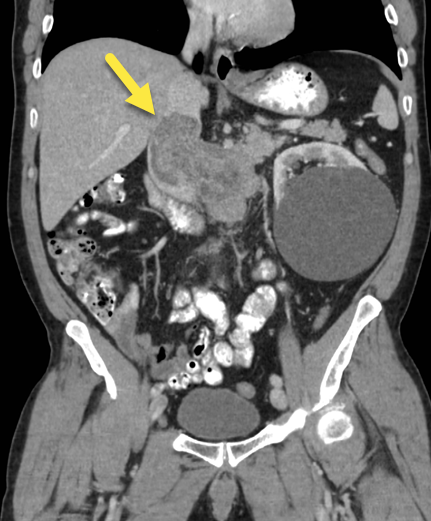 look like tumor invasion of renal vein into cava; but there is no renal mass; primary IVC leiomyosarcoma extending into renal vein