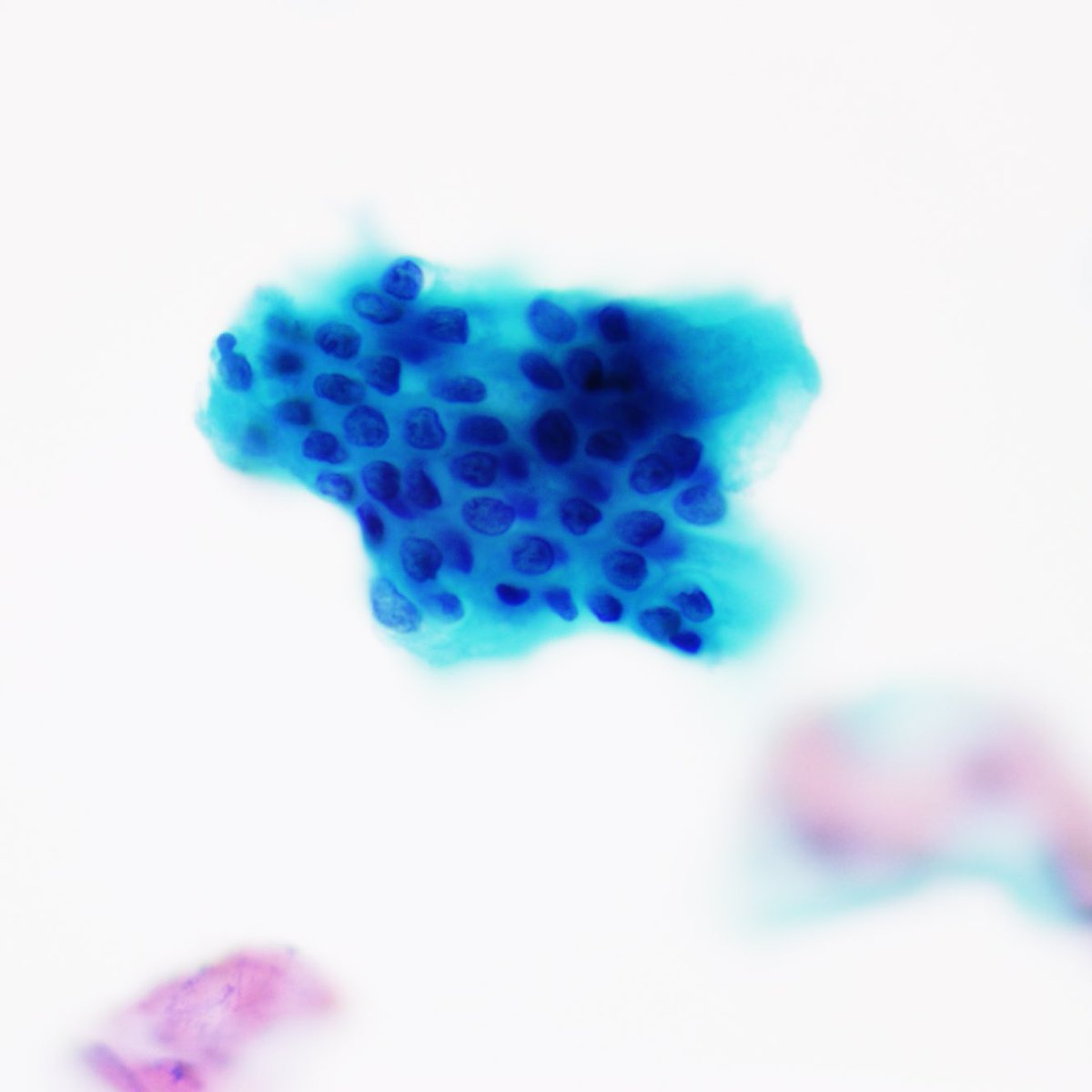 ZMaleki_cyto's tweet photo. Glandular epithelium, Anal Pap, #SurePath, Cytopathology #87 #CytoPro @barkanga @PathPro @doc_kartik @ALBoothMD @cytosantos @britishcytology @IACytology @elena_vigliar @IvanaKholova @mdlozanoe @tlabiano @MauroSaieg @eva_wojcik @tlabiano https://t.co/90XVC95YCl