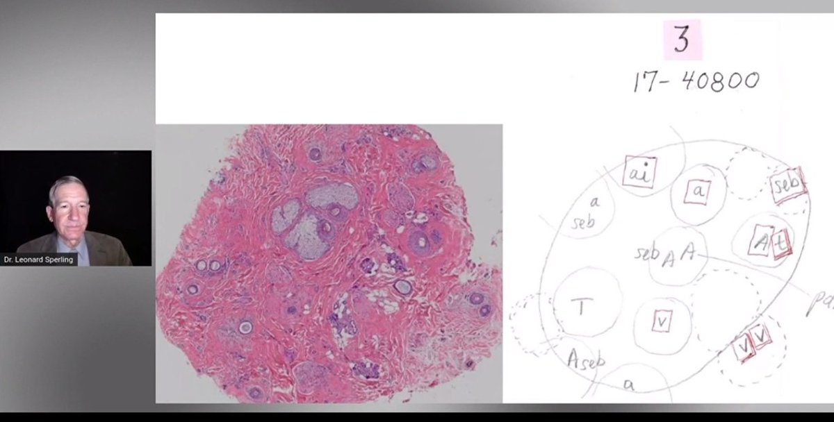 GuilleRamosPath's tweet image. #ASDP20 What an amazing event!! Last day with the alopecia legends /// Increíble congreso! El último día con las leyendas en alopecia