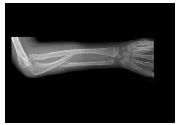 Открытый перелом кости руки. Перелом лучевой кости рентген. Перелом Монтеджи рентген. Перелом лучевой кости рентген снимок. Рентген перелома кости предплечья.