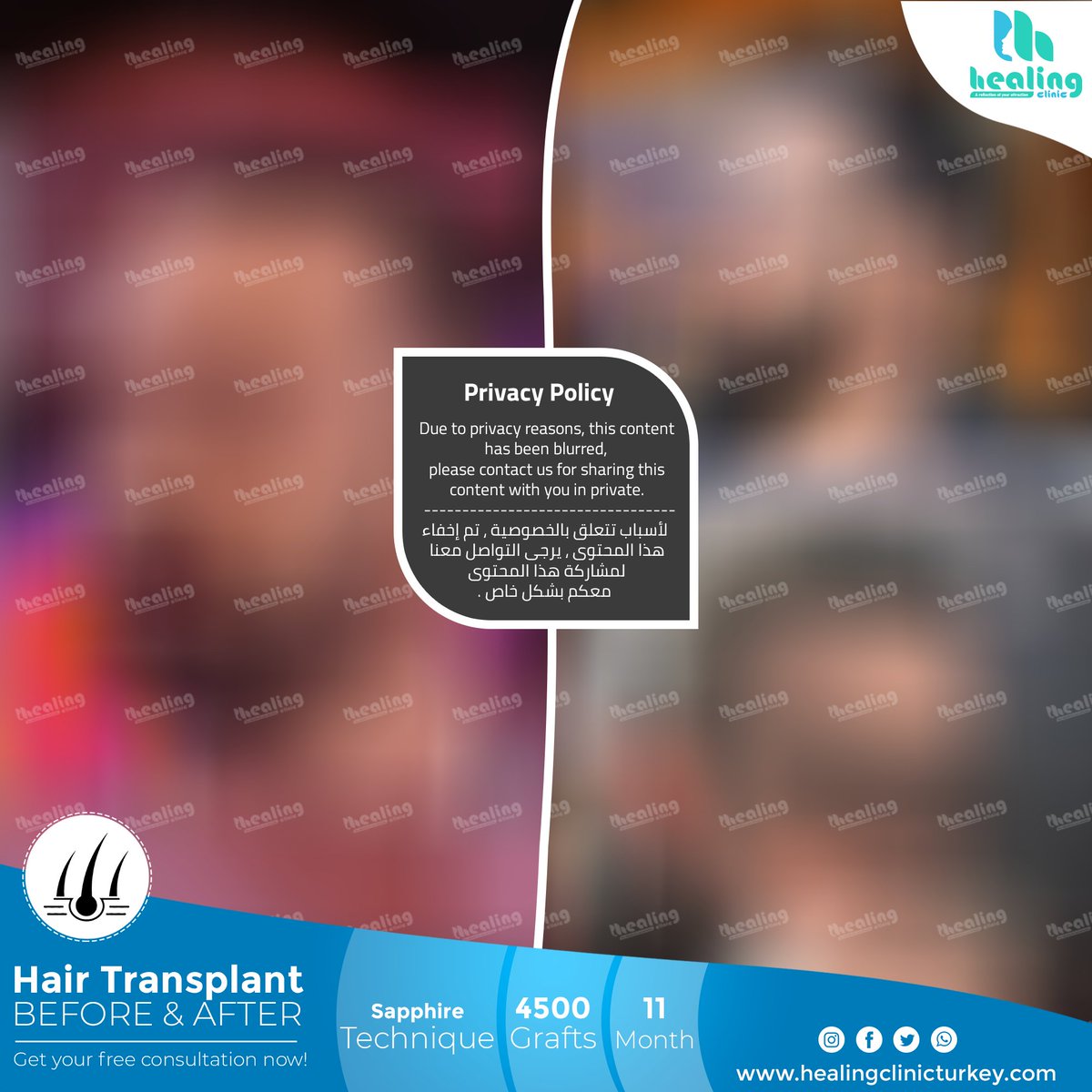 HealingClinicTR's tweet photo. Healing Clinic Turkey ⭐A reflection of your attraction⭐
هيلينك كلينيك تركيا ⭐الانعكاس لجاذبيتك⭐
Phone: +90 552 233 99 33
WhatsApp: https://t.co/jrVDhlwhDl
Website: https://t.co/azU6S5ZcYm
#choi #dhi #fue #hairtransplant #sapphire #prp #hairtransplantation #ekimi #hair https://t.co/ZmeCCHkWqH