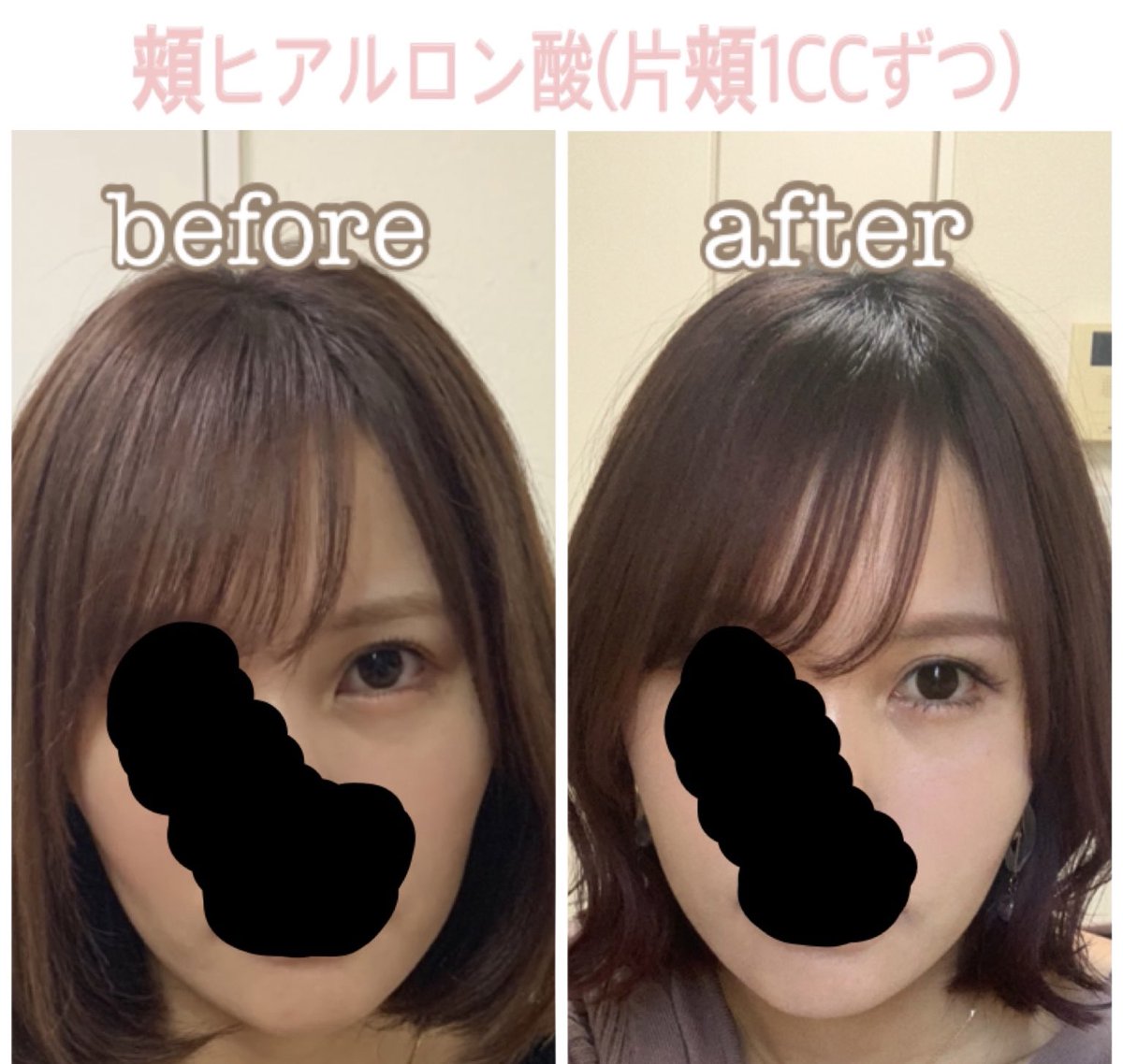 それゆけちゃん Pe Twitter ヴェルヴェットスキンの直後の赤み 大体5日くらいで腫れ赤み治まった 頬は脂肪移植と迷ってたけど定着率4割とかだし 吸収されるまで顔パンパンだからヒアルにした ヒアルの種類はスターフィル