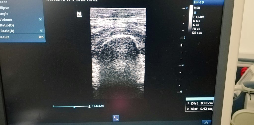 BMarinhos's tweet photo. You feel rewarded when you see your colleagues doing something you taught them!
#renaldietitian 
#clinicalnutrition 
#nutritioncareprocess 
#renaldietitian https://t.co/Y8wM16yjPI