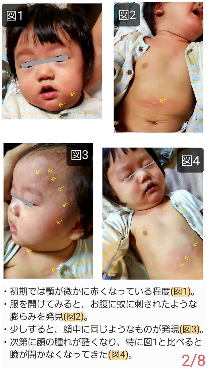 miiimama_3140's tweet photo. 先日、私が軽率だったため息子が大変なことになってしまったので情報を共有します。
皆様の事前予防や事後対処に役立てばと思います😳

これから離乳食で卵など試す方は気をつけてね！

⚠️症状の写真もあるので、苦手な人は注意してください⚠️

→続く https://t.co/b3HzQDoJ9C