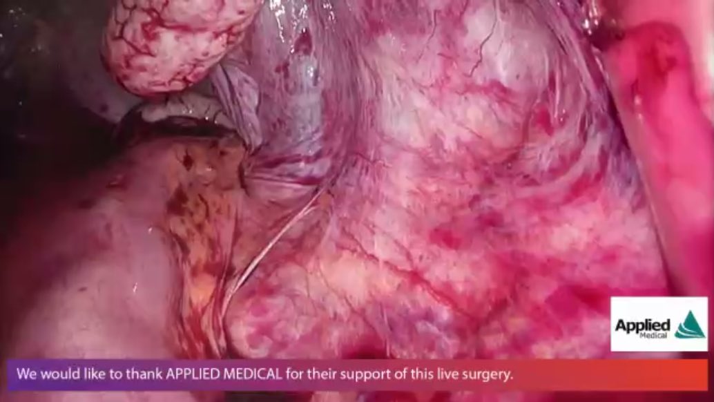 AppliedMed_GYN's tweet photo. Visualization 💯. Impressive approach to this large uterus by Dr. Jan Baekelandt. #vNOTES #AAGL20 https://t.co/AfQP1LMtEJ