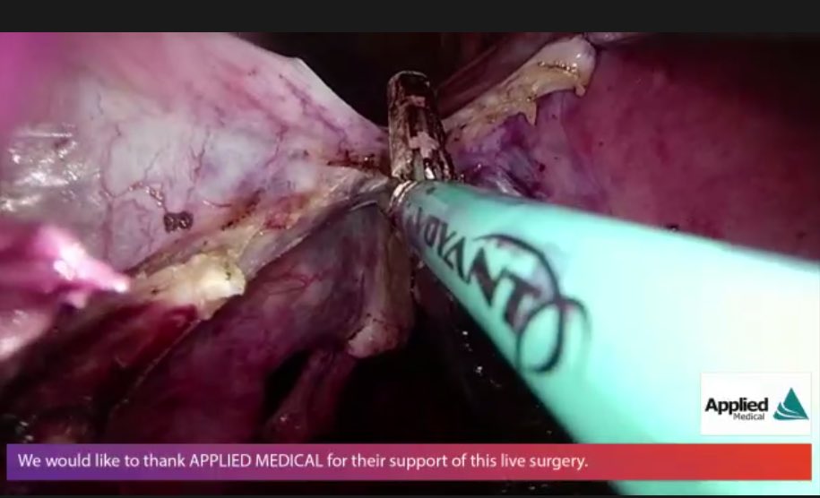 AppliedMed_GYN's tweet photo. Visualization 💯. Impressive approach to this large uterus by Dr. Jan Baekelandt. #vNOTES #AAGL20 https://t.co/AfQP1LMtEJ