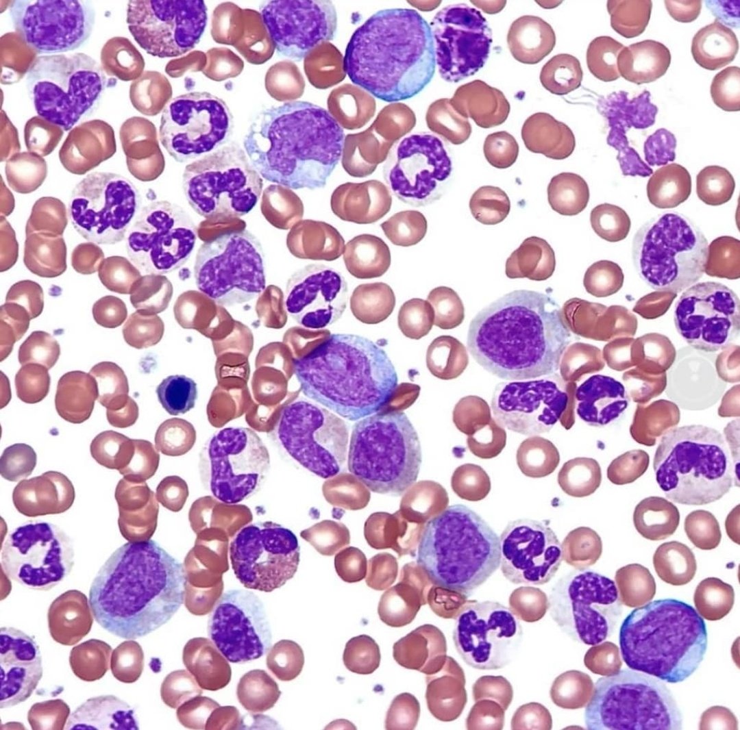 Leucemia Mieloide Crónica. 🔬