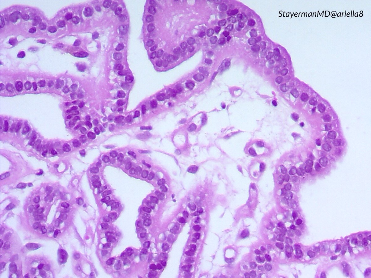 ariella8's tweet photo. #GUPath 
Fem on her 80s,pT2  HG urothelial carcinoma 1 year ago ,received radiotherapy ,now bx from inflammed retrotrigonal area  .I favor a benign proliferation ,maybe nephrogenic adenoma/metaplasia,am I being too B9 ?
Please your thoughts  and IHC request if you would recommend https://t.co/JEqVxLZTd0