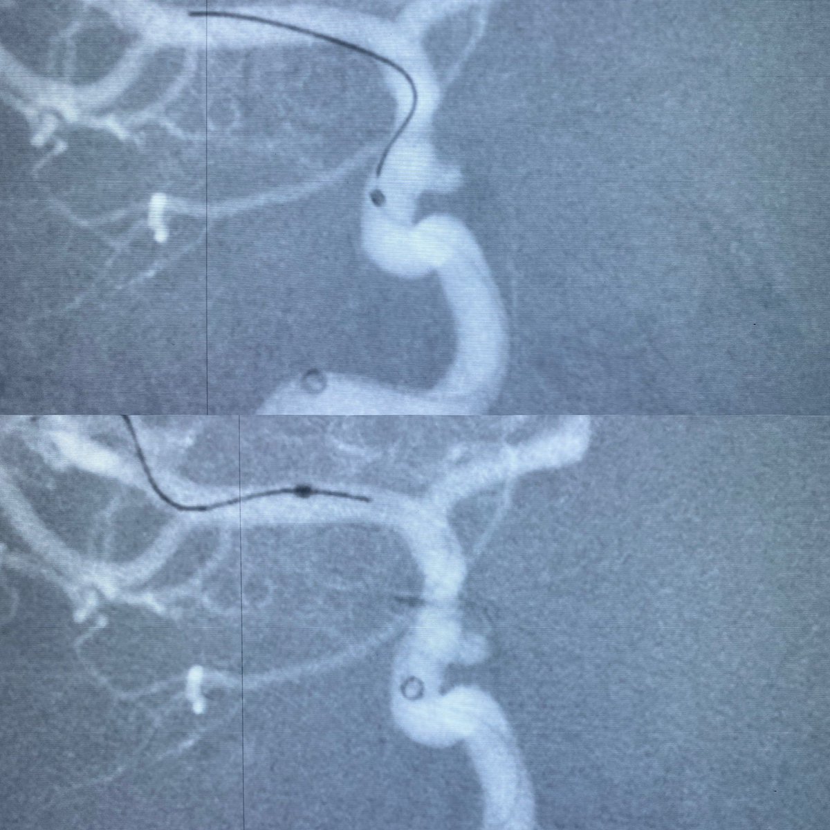 MontenegroAlfre's tweet photo. Iniciado con Pipeline Shield en @innnmvs #neuroradiology @Medtronic @MDTLATAM @NeuroVascGT @neuro_ir https://t.co/QdDu97n1il