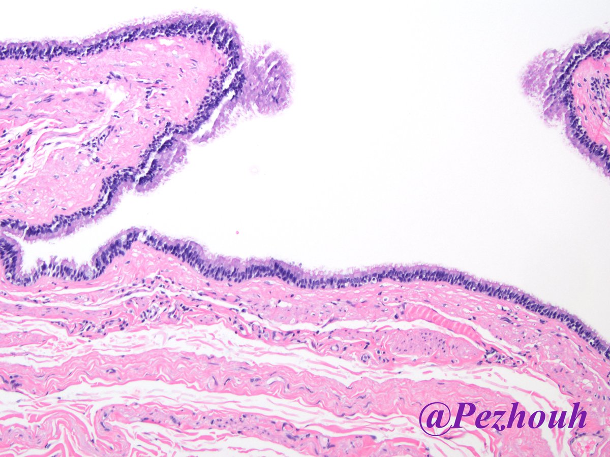 pezhouh's tweet photo. Something I don't see every day! Ciliated hepatic foregut cyst:
🔶 Arise from embryonic foregut
🔶 Segment 4 of liver
🔶 4 layers (1. Ciliated columnar epithelium, can have goblet cells 2. Smooth muscle 3. Connective tissue 4. Fibrous capsule) #liverpath https://t.co/uzAC6Mdrb9 https://t.co/iL7zJpc8zq