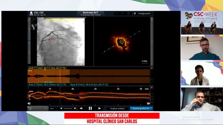 belcid7's tweet photo. Ejemplo de cómo abordar las lesiones coronarias severamente calcificadas con @NievesGonzalo1 en #CSCWeek @helenatmCARDIO @JorgPalazuelos @oriolrodriguez5 @beavaquerizo @CSC_interv @shci_sec @ShockwaveIVL @PCRonline https://t.co/BqopCmSj49