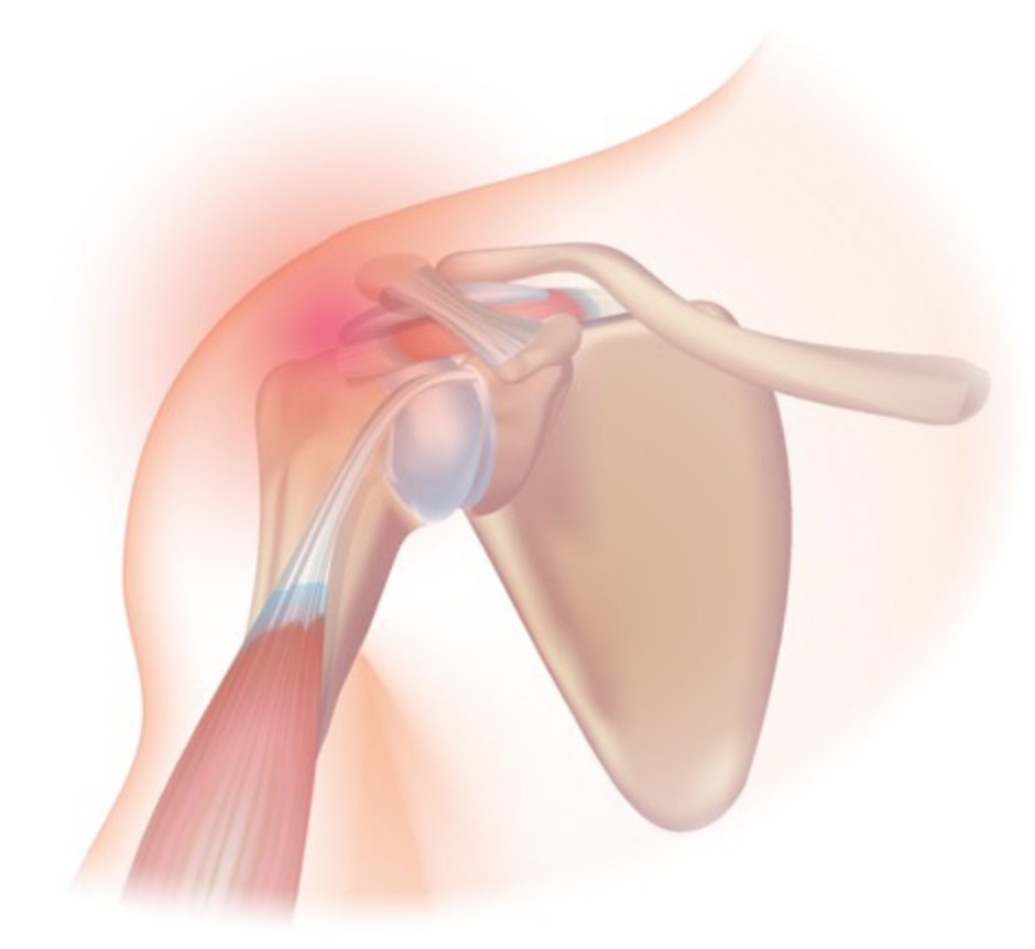 MillettMD's tweet photo. The classic symptom of #shouldertendonitis is #rotatorcuff pain, commonly radiating from the outer arm to several inches below the top of the shoulder. Other symptoms of rotator cuff tendonitis include pain & swelling in the front of the shoulder...https://t.co/8wHD8V7GbQ https://t.co/krnxi719ks