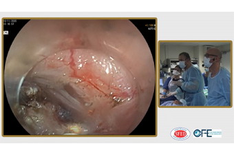 SFED_Endoscopie's tweet photo. e-Vidéo-Digest, c'est ce vendredi 13 novembre et en accÚs gratuit pour tous : connectez-vous à partir de https://t.co/hd90pxYoqD ou https://t.co/ZXpiSHIp7D #sfed #endoscopie #eVidéoDigest https://t.co/7zGXR0rCFQ