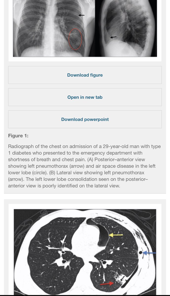 When immunocompromised patients get hit with Aspergillosis...50% fatality rate.Tad higher than C19.Remington tracks this back to a cannabis vaporizer.Vaporizers use nebulization to create Cannabinoid aerosols. Not hot enough to sterilize https://www.cmaj.ca/content/187/17/1305