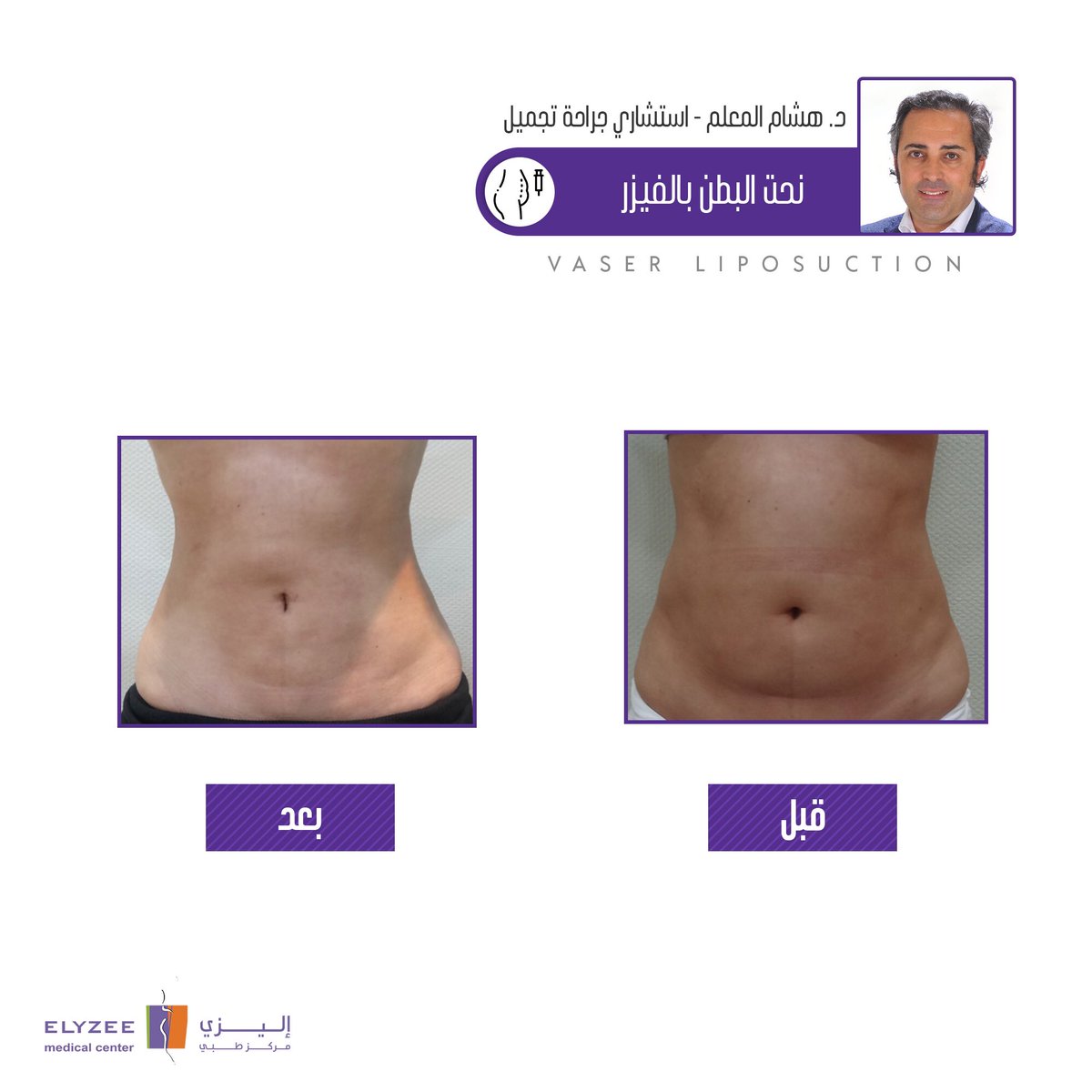 ElyzeeCenter's tweet photo. حالة من حالات الاستشاري هشام المعلم
#نحت_البطن بتقنية #الفيزر  #قبل_بعد

🔻متواجد بمركزنا لفترة وجيزة من ٢٨/١١ وحتى ٤/١٢ احجز موعدك الآن!

#تجميل #جراحة #شد_البطن #نحت_الجسم
#الخميس_الونيس #ليله_الجمعه #ماهو_المهر_المناسب_للزواج #وظايف_نساييه #اكشن321 #تجميل_الانف #تجميل_الصدر https://t.co/dUaTOgC2gO
