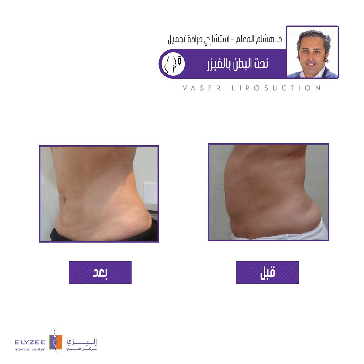 ElyzeeCenter's tweet photo. حالة من حالات الاستشاري هشام المعلم
#نحت_البطن بتقنية #الفيزر  #قبل_بعد

🔻متواجد بمركزنا لفترة وجيزة من ٢٨/١١ وحتى ٤/١٢ احجز موعدك الآن!

#تجميل #جراحة #شد_البطن #نحت_الجسم
#الخميس_الونيس #ليله_الجمعه #ماهو_المهر_المناسب_للزواج #وظايف_نساييه #اكشن321 #تجميل_الانف #تجميل_الصدر https://t.co/dUaTOgC2gO