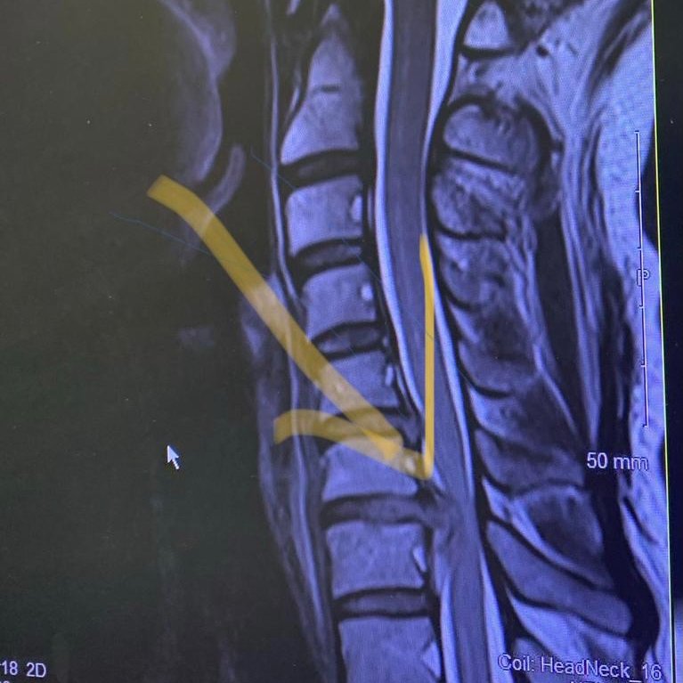 Case study 1. 41 yo female presents with 2/52 history of mild neck soreness, bilateral arm pain to elbow, and bilateral vague ‘wooly feeling' in feet. Previously diagnosed elsewhere – via telehealth - with ‘stress related neck pain, and sensitised nerves’. No neuro exam. 1/