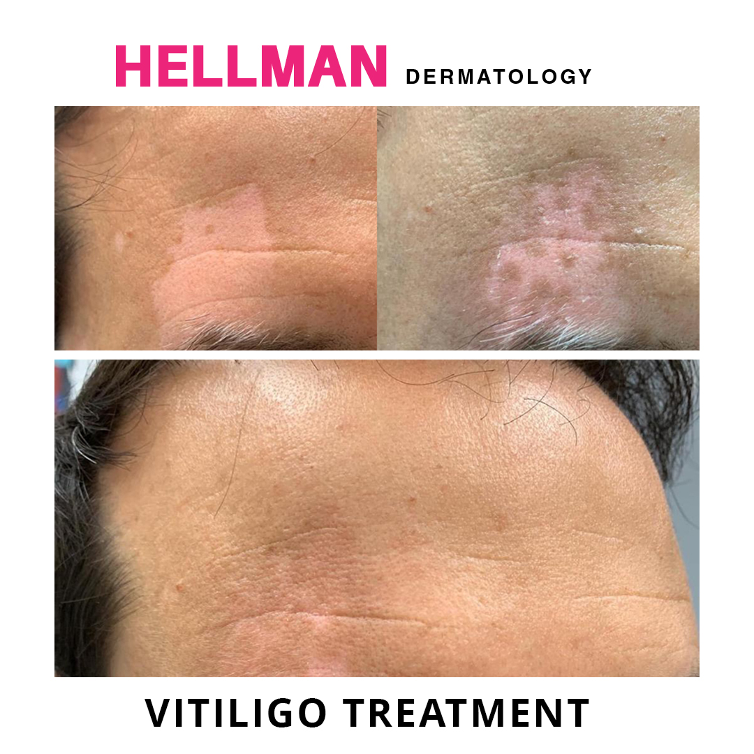 In these photos, Dr. Judith Hellman used a customized treatment to restore the skin color of a patient suffering from vitiligo.

#nycderm #nycdermatologist #dermatologistnyc #cosmetictreatments #drjudithhellman  #cosmeticdermatologist #bigappleskin #hellmandermatology #vitiligo