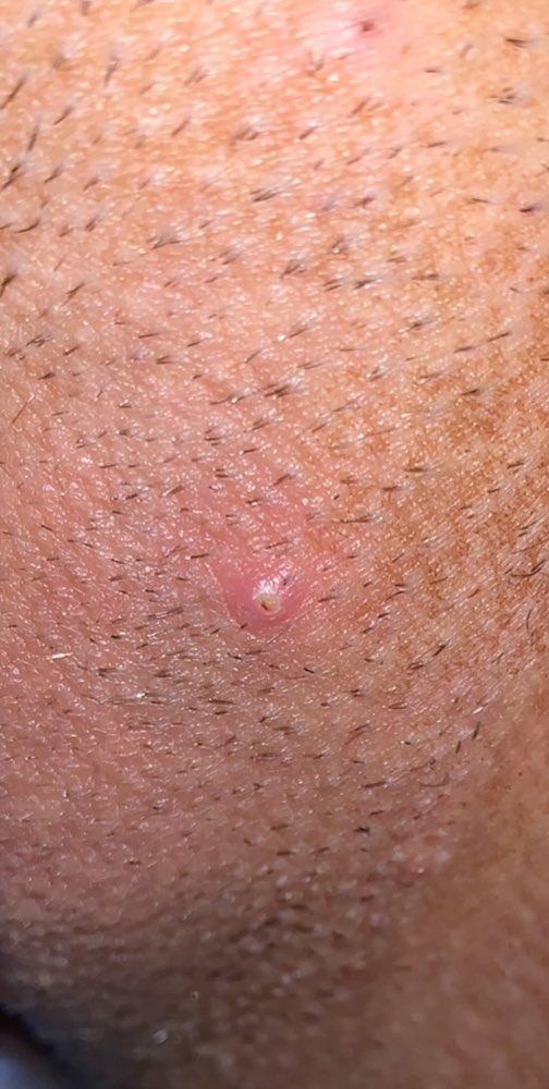 When your hair starts to grow back, especially if you have thick or a curlier hair type since the base of your hair shaft is weakened it started to down DOWNWARD this resulting in an ingrown hair.