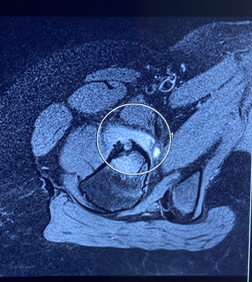 drmanishy's tweet image. #osteoidosteoma is a benign condition of bone affecting young individuals causing pain. #IRad can treat these lesions by #Imageguided #Ablation. pain free and active after procedure. @sayedsalal  @ISVIRIndia @SIRRFS @cirsesociety @hospital_kims