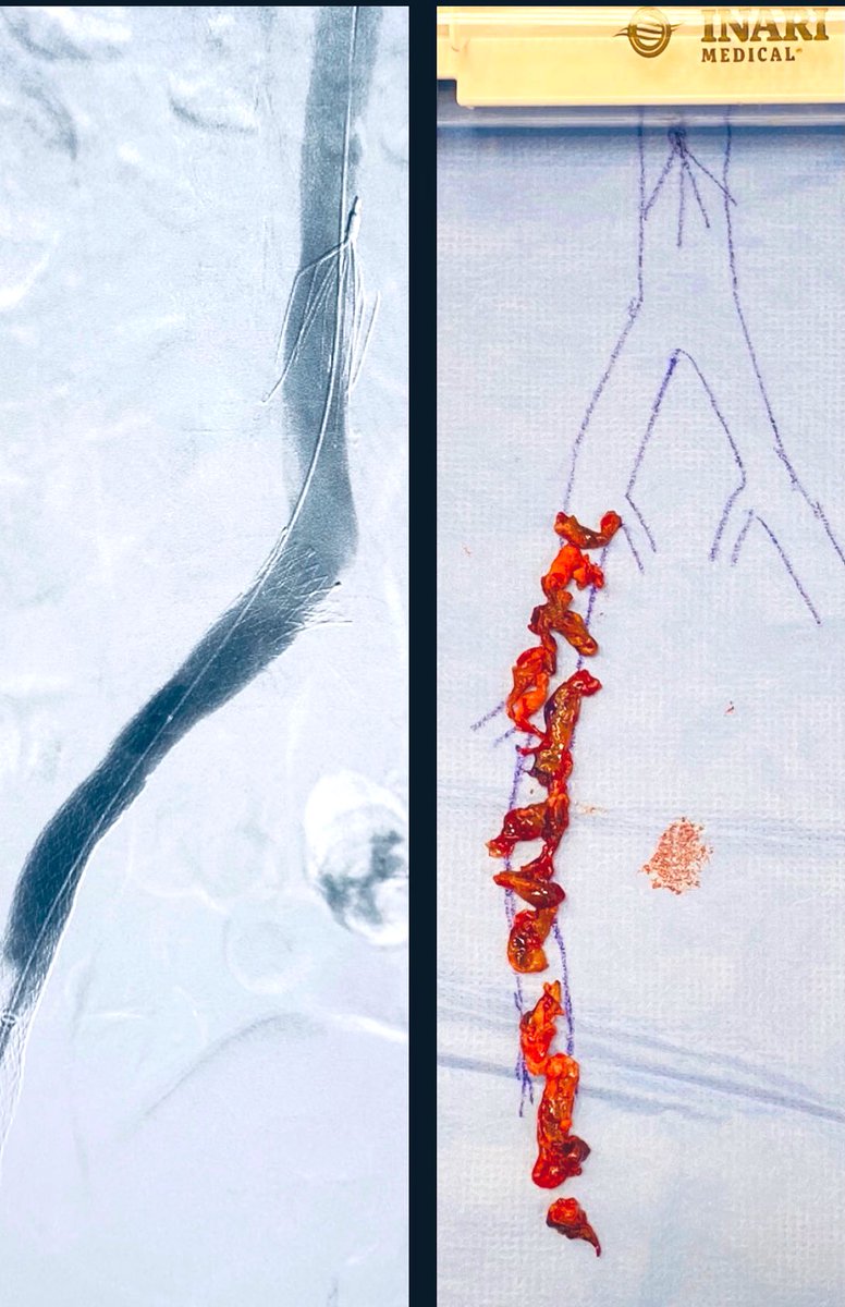t_intheleadcoat's tweet photo. Postphlebitic syndrome, a tough conundrum for pts &amp; Rx physicians.
Thx to options we have now... WE have a fighting chance esp when complicated by ulcers ! 

Recurrent DVT (10 yrs) LLE, #MTS Rx 
Inflow #singlesessionthrombectomy @InariMedical , 
outflow-> Venovo 
#IRad 
@farkomd https://t.co/JL7Z0vBsDQ