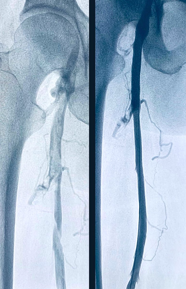 t_intheleadcoat's tweet photo. Postphlebitic syndrome, a tough conundrum for pts &amp; Rx physicians.
Thx to options we have now... WE have a fighting chance esp when complicated by ulcers ! 

Recurrent DVT (10 yrs) LLE, #MTS Rx 
Inflow #singlesessionthrombectomy @InariMedical , 
outflow-> Venovo 
#IRad 
@farkomd https://t.co/JL7Z0vBsDQ