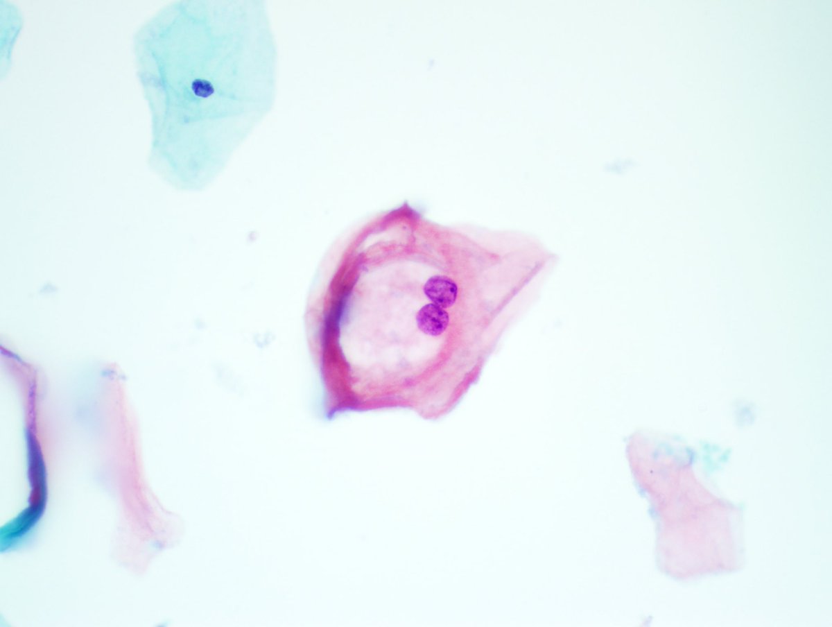 ZMaleki_cyto's tweet photo. Low-grade Squamous Intraepithelial Lesion, Anal Pap, #SurePath, Cytopathology #88 #CytoPro @barkanga @PathPro @doc_kartik @ALBoothMD @cytosantos @britishcytology @IACytology @elena_vigliar @IvanaKholova @mdlozanoe @tlabiano @MauroSaieg @eva_wojcik @tlabiano @NayarRitu https://t.co/RsyAzF6U0S