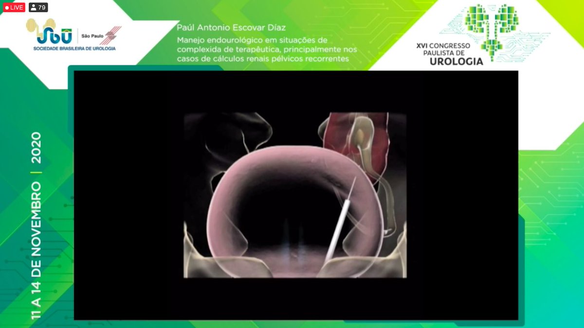 MaroccoloMarcus's tweet photo. Prof. Paul Escovar Diaz compartilhando sua experiência de 6 casos de litiase em rim pélvico com abordagem transvesicorenal #CPU2020 #UroSoMeBrasil https://t.co/OJ7dApqvCg