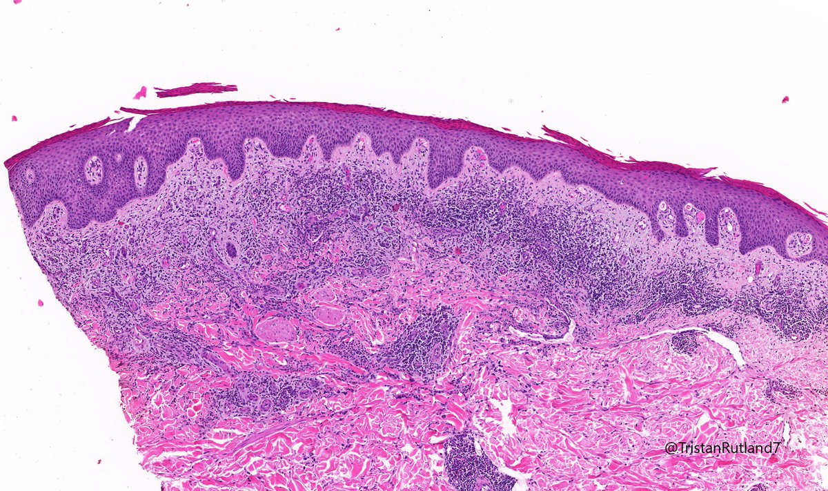 Patient had other lesions on body (mainly trunk).