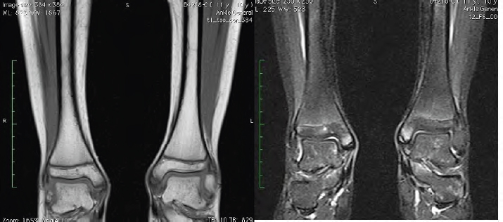 ctod_editor's tweet photo. #CTOD [Original Article] Traction apophysitis of the medial malleolus
#tractionapophysitis #medialmalleolus

https://t.co/JjAZrEla7i https://t.co/33rM1jafVF