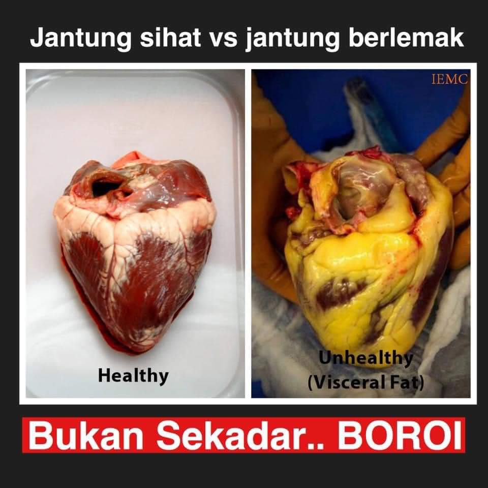 health_malaysia's tweet photo. [INFO] Bukan Sekadar Boroi

Sila ambil perhatian sekiranya anda memiliki: 

 ✅ Ukur lilitan pinggang melebihi 35 inchi bagi wanita
✅ Ukur lilitan pinggang melebihi 40 inchi bagi lelaki.

Ini adalah thread. https://t.co/oQUR9xuZWd