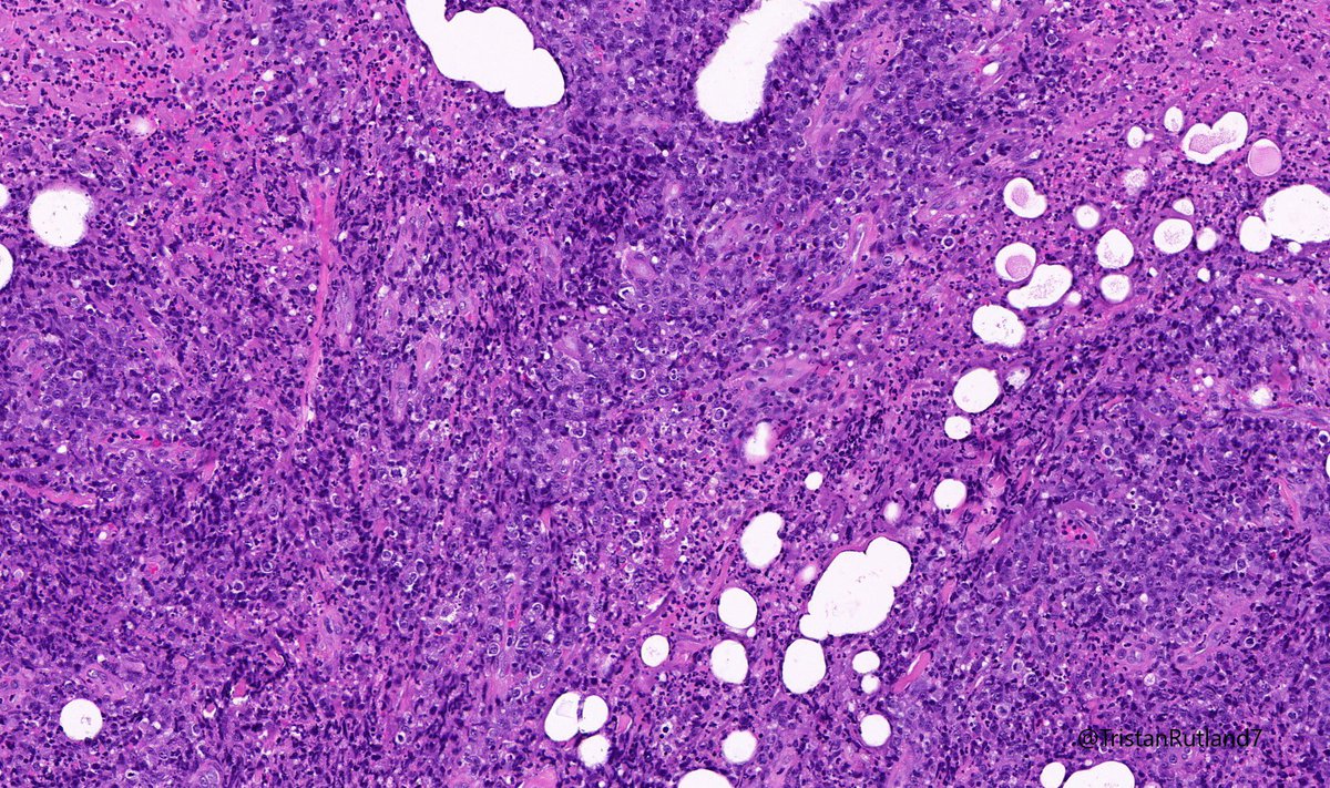 Female, adult, leg.  @ZHOUSEH  @MattieFarzin  @rennmont  @DrJPLow  @JMGardnerMD  @DrGeeONE  @Kashifhazim  @Divya_Madhala  @Meghna0630  @ariella8  @pembeoltulu  @MAHoureih  @ChristineJKoMD  @rdpatho   #dermpath  #pathtwitter  #pathology