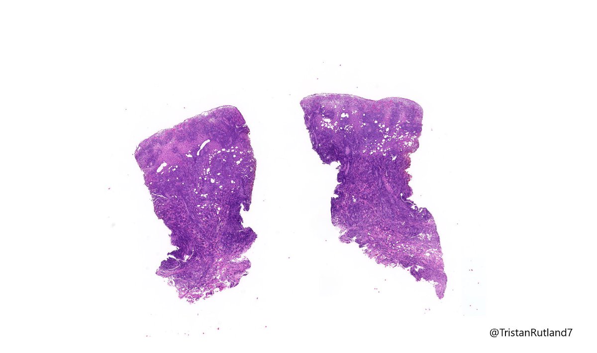 Female, adult, leg.  @ZHOUSEH  @MattieFarzin  @rennmont  @DrJPLow  @JMGardnerMD  @DrGeeONE  @Kashifhazim  @Divya_Madhala  @Meghna0630  @ariella8  @pembeoltulu  @MAHoureih  @ChristineJKoMD  @rdpatho   #dermpath  #pathtwitter  #pathology