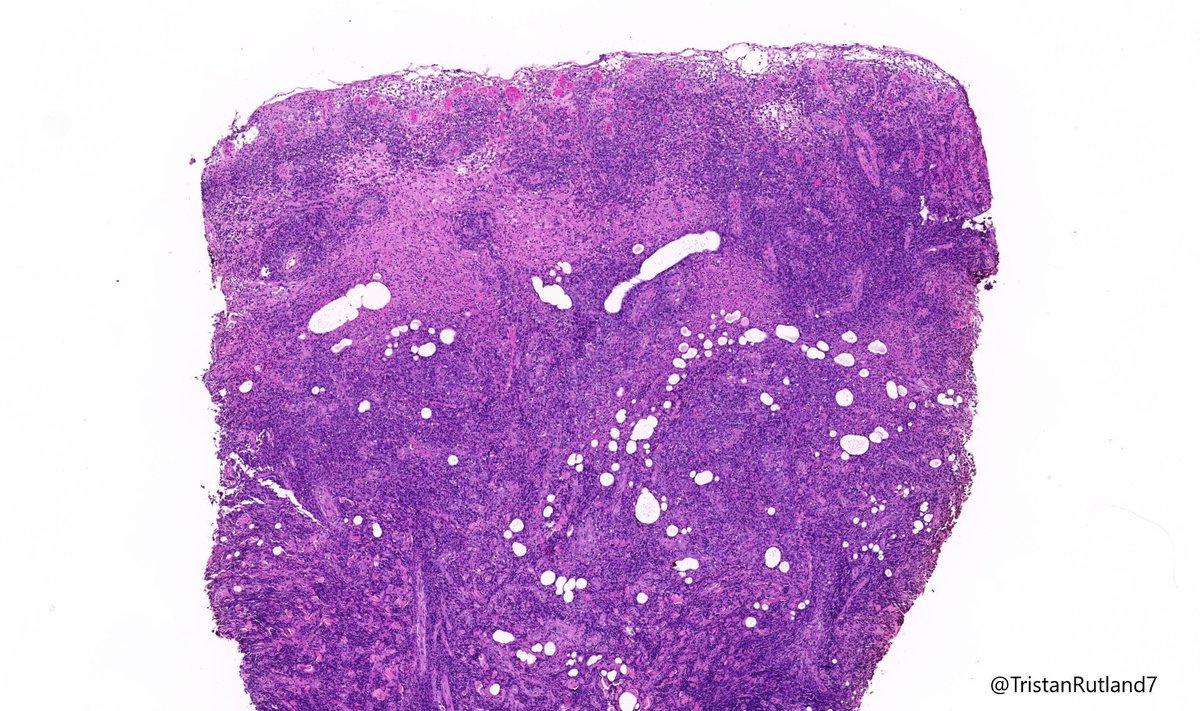 Female, adult, leg.  @ZHOUSEH  @MattieFarzin  @rennmont  @DrJPLow  @JMGardnerMD  @DrGeeONE  @Kashifhazim  @Divya_Madhala  @Meghna0630  @ariella8  @pembeoltulu  @MAHoureih  @ChristineJKoMD  @rdpatho   #dermpath  #pathtwitter  #pathology