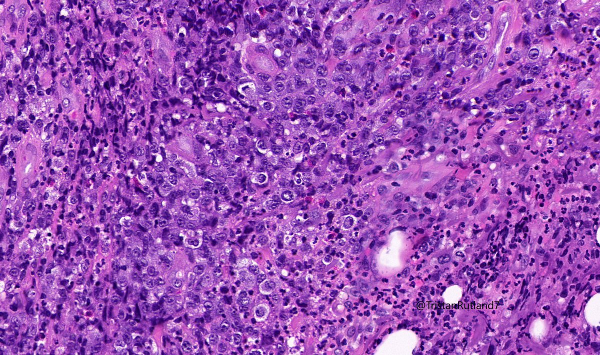 Female, adult, leg.  @ZHOUSEH  @MattieFarzin  @rennmont  @DrJPLow  @JMGardnerMD  @DrGeeONE  @Kashifhazim  @Divya_Madhala  @Meghna0630  @ariella8  @pembeoltulu  @MAHoureih  @ChristineJKoMD  @rdpatho   #dermpath  #pathtwitter  #pathology