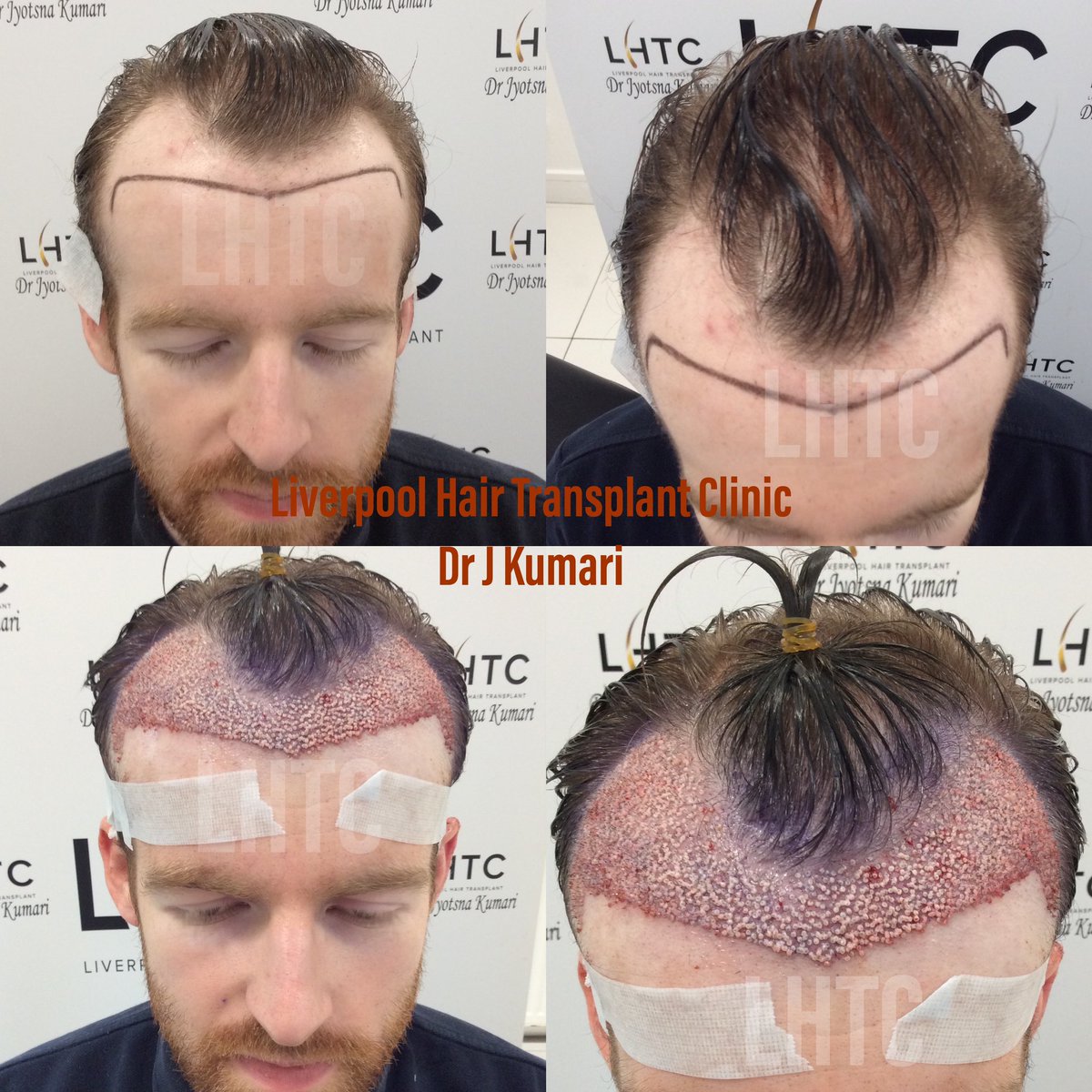 Liverpool Hair Transplant Clinic on Twitter: Liverpool Hair Transplant Clinic on Twitter:
