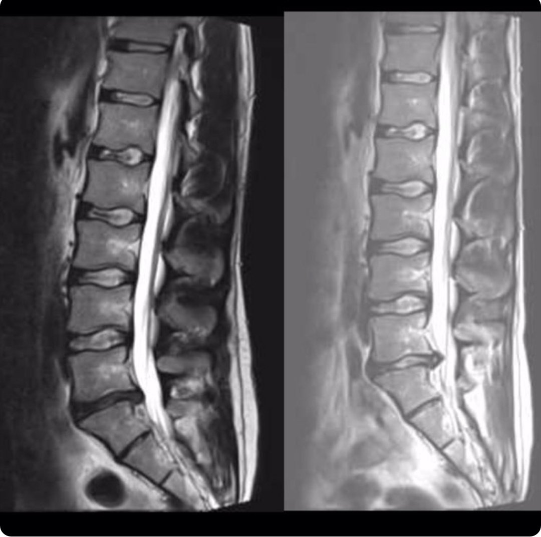 Physiotherapists. Basic mobility/ROM work for lumbar spine which he does & no change. Has been referred to neurosurgery as intensity of pain & function have not improved. Here is his scan. Left 2017, right this week.