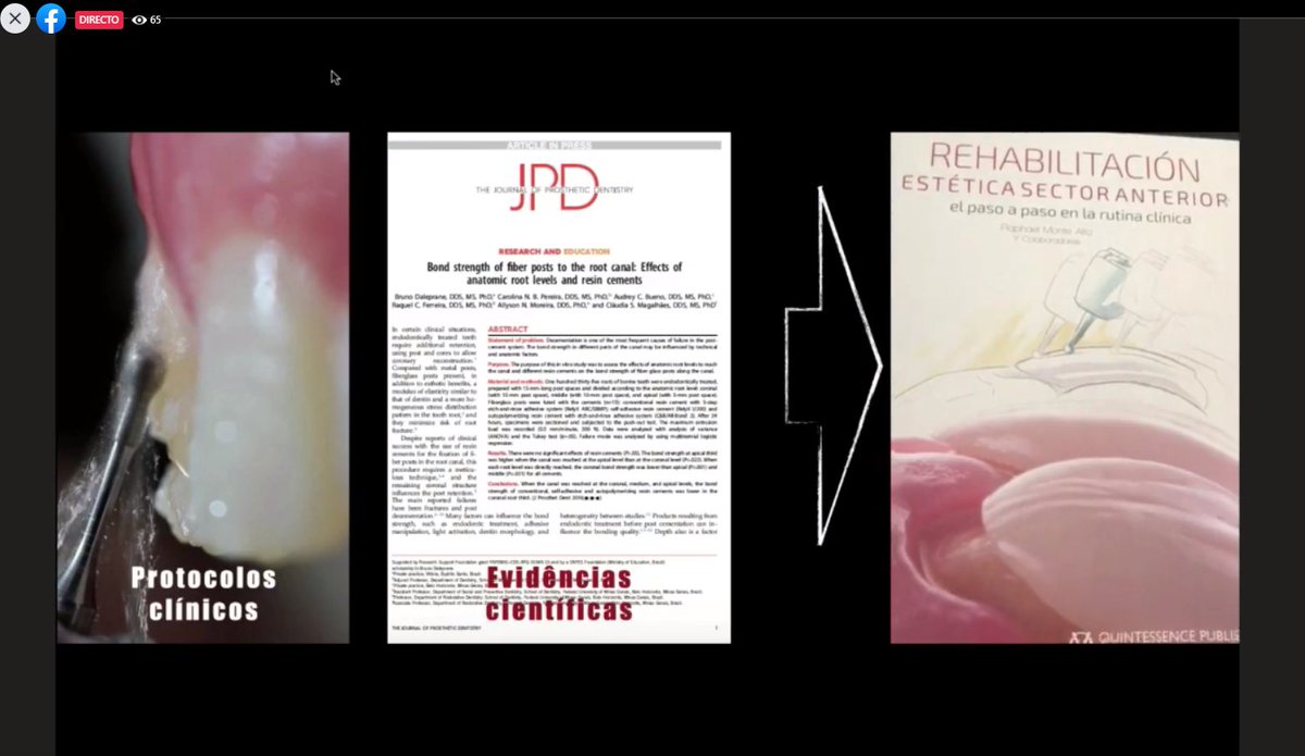 YA INICIAMOS!! SUMATE! ÚLTIMO WEBINAR! Dr. Raphael Monte Alto | Restauraciones cerámicas en el flujo digital 1º Congreso Latinoamericano ALODYB DIGITAL! 🤝
REGISTRESE attendee.gotowebinar.com/register/56475…
#alodyb #AlodybDigital #CongresoInternacional #webinargratuito #webinarodontologia