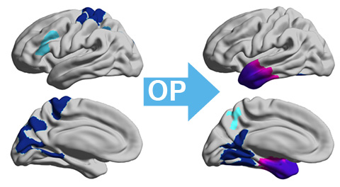 Temporal lobe epilepsy is associated with progressive cortical atrophy. Galovic et al. show that successful epilepsy surgery prevents further neurodegeneration and may be neuroprotective. bit.ly/2GWElIv