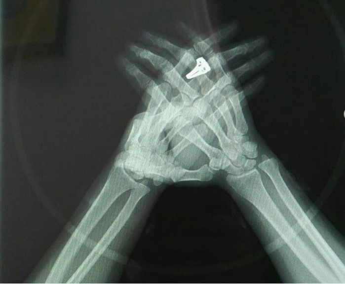 rachadizahira's tweet photo. My X-Ray clapping hands 😊
#iClapfor @ianberry_art  
#COVID19_Will_end https://t.co/O4KL7pIuoM