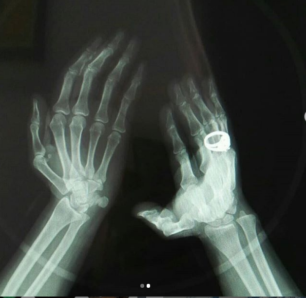 rachadizahira's tweet photo. My X-Ray clapping hands 😊
#iClapfor @ianberry_art  
#COVID19_Will_end https://t.co/O4KL7pIuoM