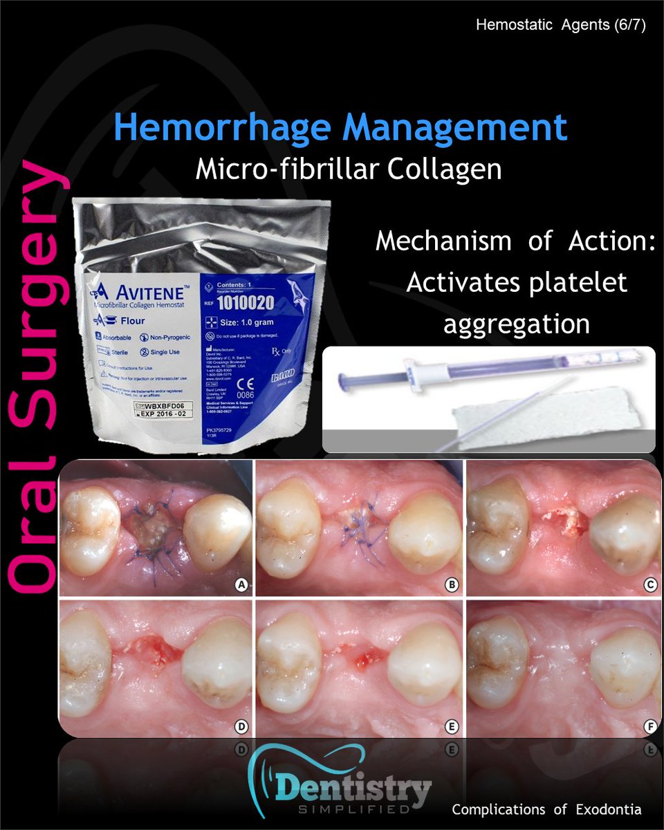 Dent_Simplified's tweet photo. Hemorrhage management: Micro-fibrillar collagen

#Dentistrty #Oral_Health #mds #dds #mdsprep  #mdspreparation  #next_exam #bds  #dental #dentistry #dentists #dentalstudent #dentalcare #nbe #neet_dental #Endodontics #Endo #oralmedicine #medicine #oralsurgery #OMFS #nbde https://t.co/a0qbYps49d